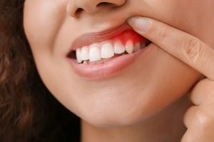 Take care of teeth with home remedies